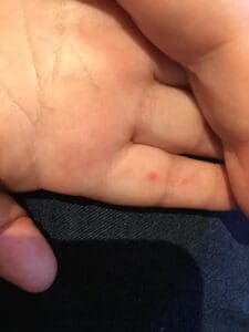 the start of hand foot and mouth disease, red spots appear on the fingers of a young childs hand, 